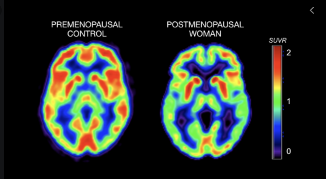 Brain changes post-menopause