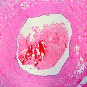 endometriosis-of-the-fallopian-tube